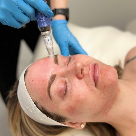 The Many Benefits of Microneedling: Collagen Banking for Better Skin