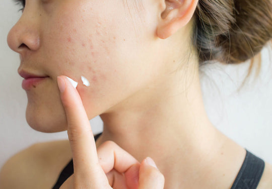 3 Common Types Of Acne And How To Treat Them